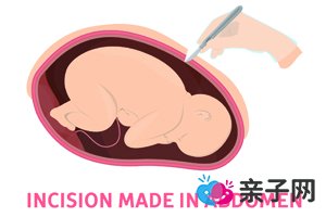 剖腹产多久用束腹带